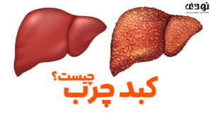 کبد-چرب-300x169 کبد چرب یا استئاتوز چیست؟