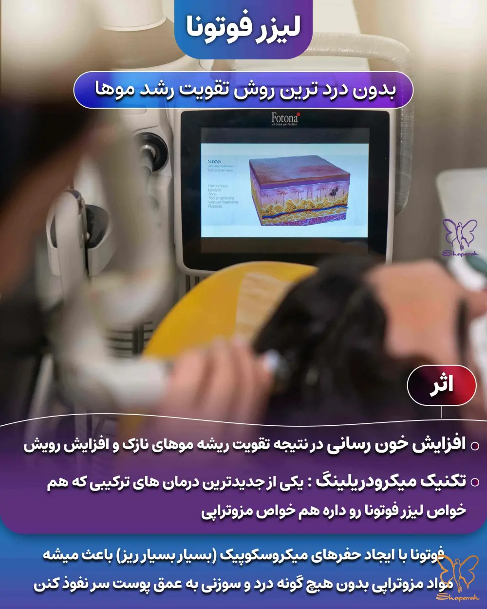 668833944o_1is85tvme1fov4p2b5255k4d923_.webp جدیدترین درمان ریزش مو در مشهد؛ معجزه لیزر فوتونا و PRGF در کلینیک شاپرک