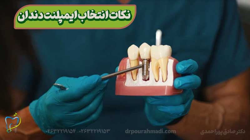 4 نکته ای که انتخاب ایمپلنت رو برای شما ساده تر میکند